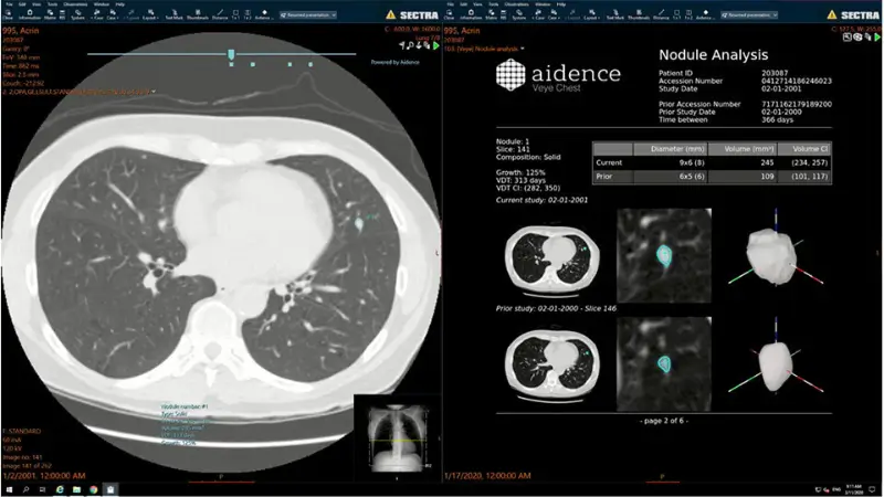 Veye Lung Nodules™