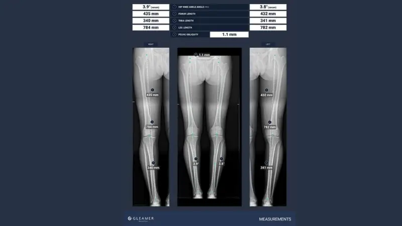 BoneMetrics™