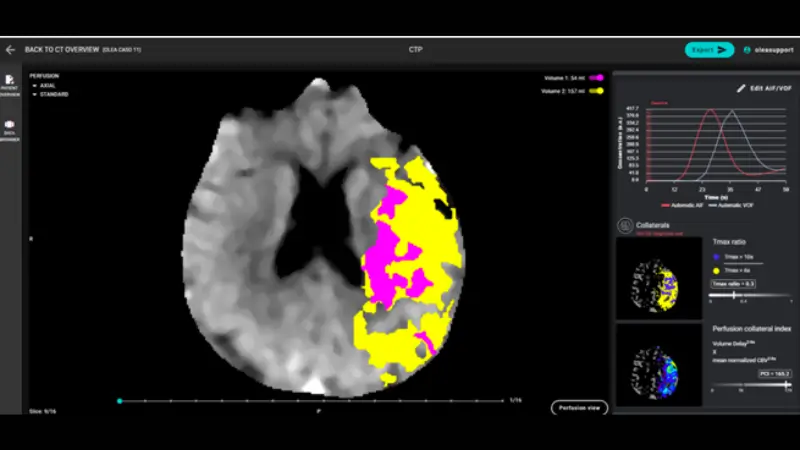 CT Perfusion